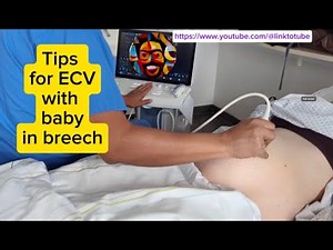 ECV baby spinning plain and simple. How it's done to reduce cesareans #breechbaby #breech #manuver