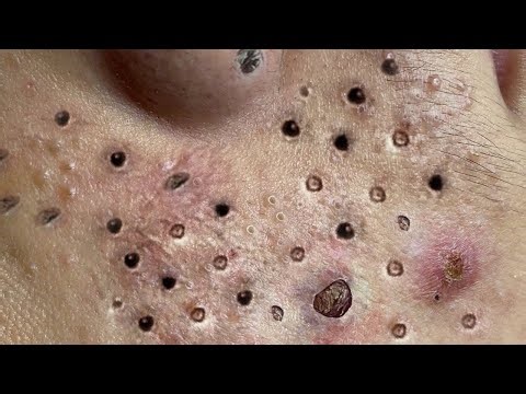 Blackhead Removal With Sac Dep Spa @100074774