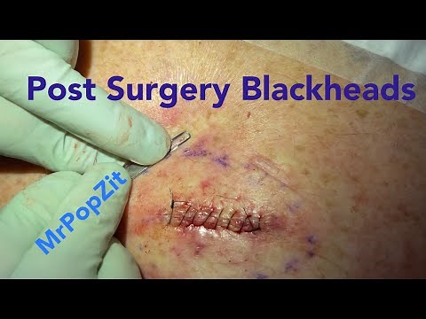 Ingrown hair blackhead extractions post surgery. Surgery video coming soon! MrPopZit.