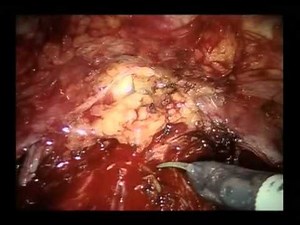 Robot-assisted Radical Cystectomy And Intracorporeal Urinary Diversion - Part 1