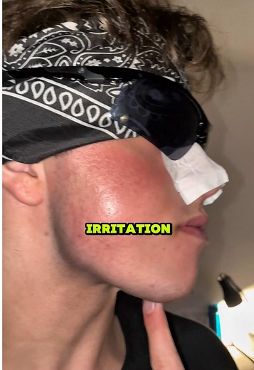 Trying everything to get rid of blackheads #blackheads #noseporestrips