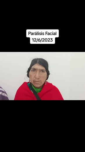 Conoce la recuperación de una parálisis facial #paralisisfacial #tratamiento #terapia #parati