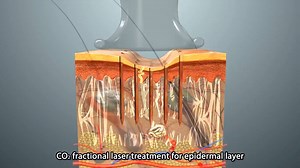 #FraxisDuo #Co2 #MicroneedlingRF #AllSkinTypes #SkinLifting #SkinTightening #AcneScars #USFDAapproved | Skinnovation Pvt Ltd