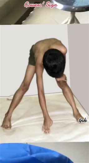 Understanding Gowers' Sign in Duchenne's Muscular Dystrophy