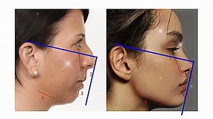 Forward facial growth, defined model face, high radix and nose bridge