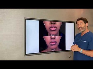 Lip Reduction- Bikini Technique