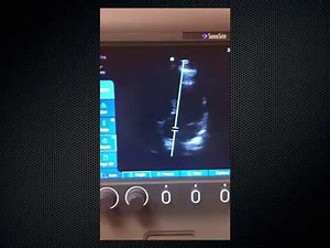 Cardiac/heart ultrasonography/2d echo