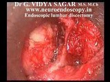 Endoscopic Lumbar Discectomy  • Video • MEDtube.net