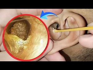 WARNING: Deep, Infected Earwax Extraction! | Dry & Crusty ASMR Ear Cleaning | EP 71