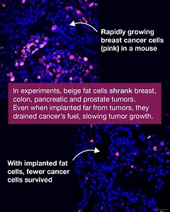 What if fat cells could fight cancer? UCSF researchers have discovered how to reprogram liposuctioned fat cells into tumor-starving beige fat cells. These calorie-burning cells steal nutrients from cancer, shrinking tumors in lab studies. Scientists hope this could reshape cancer treatment using the body’s own fat. https://tiny.ucsf.edu/p337ZB | UCSF