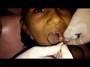 Extraction procedure of Lower Decidious Molars