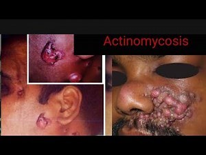 Actinomycosis Explained: Causes, Signs and Symptoms, Diagnosis, treatment, prevention