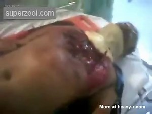 Open Chest After Car Accident