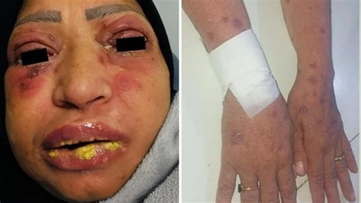 Woman's horrific reaction to ibuprofen left her oozing yellow gunk from her eyes