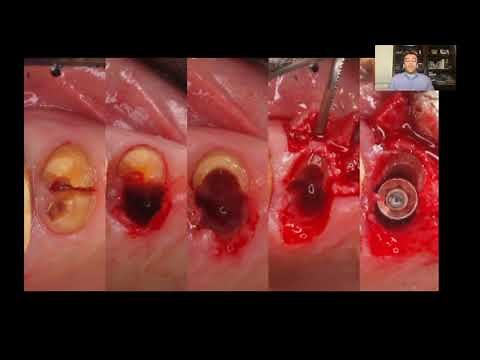 Immediate Dental Implants {Partial Extraction Therapy / Socket Shield}