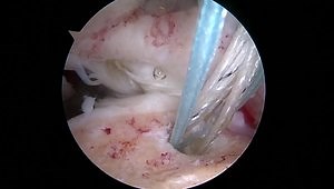 Massive Rotator Cuff Repair With Subscapularis Repair