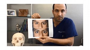 Asymmetrical Eyes: Causes and Treatment