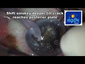 Hard intumescent cataract: step by step guide for beginners