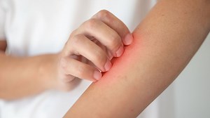 Vous avez envie de vous gratter ? Cela renforcerait votre système immunitaire selon une étude - RTBF Actus