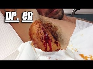 Armpit Abscess Core Removal, Part Two