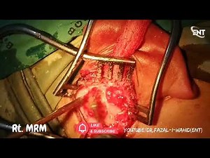 Rt Ear Modified Radical Mastoidectomy (Exteriorization)