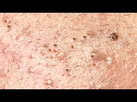 Acne Streatment With Sac Dep Spa #01