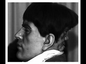 Urban Legends: The Curious Case of Edward Mordake, man with "two-faces", one in front, other in back