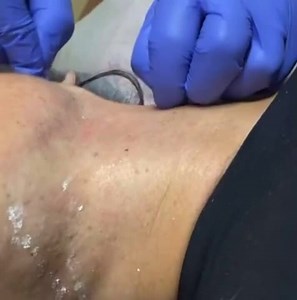 Submental area correction