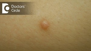 Any flesh coloured lump in any parts of the body, it is most important where it is situated to diagnose or to know what type of lump it is and how long it has been growing. That is also very important. If it is a lump of very short duration, red and it is bleeding, it could be following an injury which is an excessive granulation tissue which can look like this. There is something known as pyogenic granuloma. Due to infection, the granulation tissue can pout out, especially it is common around t