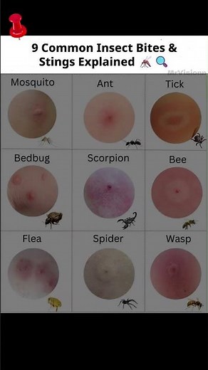 Insect Bites & Stings Explained 🐝