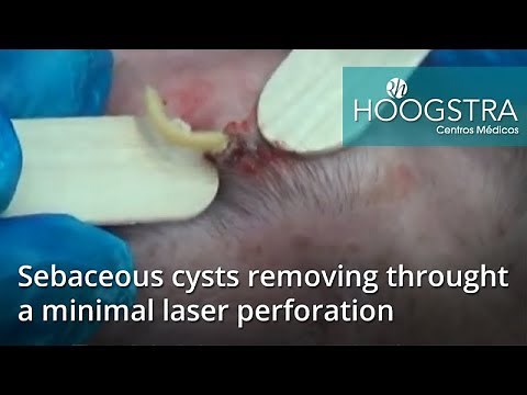 Sebaceous cysts removing through a minimal laser perforation