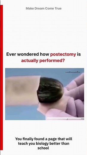 🪡 Ever wondered how ✂️ postectomy is actually performed 🧑‍⚕️ | MDCT