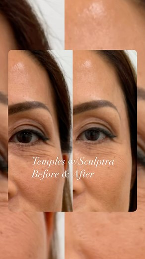 What is Sculptra? Sculptra is a cosmetic treatment that stimulates collagen production in the skin. Using poly-lactic acid (PLLA) as its active ingredient, Sculptra encourages the body to produce its own collagen, which helps improve skin elasticity, firmness, and overall volume. Unlike traditional fillers that provide immediate results, Sculptra works gradually, with effects becoming more noticeable over several weeks to months after treatment. Sculptra is commonly used to address facial wrinkl