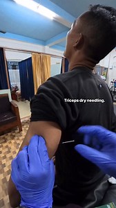 Release of triceps muscle for pain relief. Welcome to Samaritan Physiotherapy Healthcare, Gossaigaon #Kokrajhar #Gossaigaon #health #healing #painrelief Dr-Ashish Basumatary | Dr-Ashish Basumatary