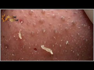 Best Satisfying Nose Plucking Blackheads Whiteheads Removal | Acne Treatment #27