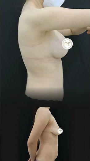 Implantes de pecho | Antes y Después 💕 #aumentodepecho #parati #belleza