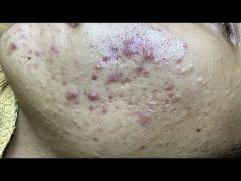 Acne Treatment For Cuong (P1)| Điều Trị Mụn Cho Cường P1 - SacDepspa#246