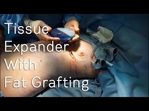 Tissue Expander Removal With Permanent Implant and Fat Grafting