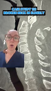 43K views · 367 reactions | Case study 133 - Broken neck in elderly. An 80yo female is diagnosed with a broken neck after suffering a fall at home. What is the type of fracture and the treatment? Stay tuned tomorrow and I’ll explain the whole case. #sundaycasestudy #ladyspinedoc#healthcareworker #hospital #surgery #neurosurgeon #medicalschool #medstudent #medicalstudent #nursing#elderly #spinefracture #brokenneck | Dr. Betsy Grunch - Ladyspinedoc | Facebook