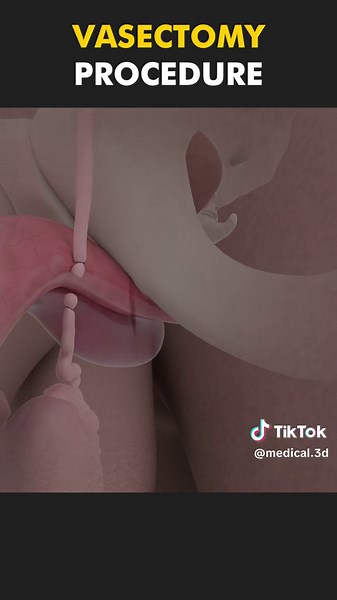 Vasectomy Procedure: 3D Animation & Patient Education