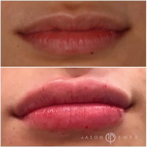 Before & After: Plump and Enhance Your Lips With Restylane Silk Injections
