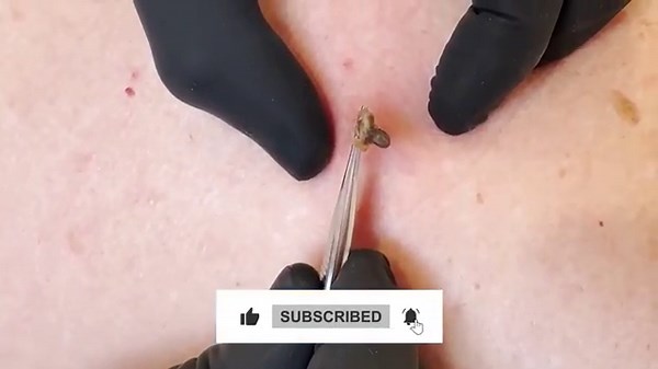 DILATED PORE OF WINER, SAC AND ALL!