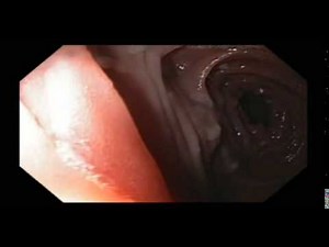 Jejunum, Benign Neoplasms, Tubular Adenomas with Dysplasia • Video • MEDtube.net