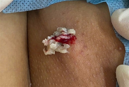 Creamy Cyst Incision and Drainage