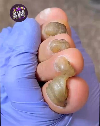 Trusted Methods to Improve Cracked Toenails That Keep Your Nails Strong #WellnessSeniors #SafeSteps #FootWellnessUSA | NC State Wolfpack on TheWolfpacker.com