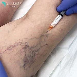 Treatment of a cluster of Spider veins & Corona Phlebectatica. ⠀ 👀Watch and listen to what the patient says after she views her veins disappearing instantly. It takes experience, art and the magic of sclerotherapy to get the results.⠀ ⠀ Book Your Appointment Now!⠀ 📲 Call 04-3498800 or visit SHAMMAclinic.com⠀ ⠀ 💉علاج مجموعة من العروق العنكبوتية والإكليل الوريدي . ⠀ 👀شاهد واستمع إلى ما يقوله المريض بعد أن شاهدت عروقها تختفي على الفور. يتطلب الأمر خبرة وفنًا وسحر المعالجة الصلبة للحصول على النت