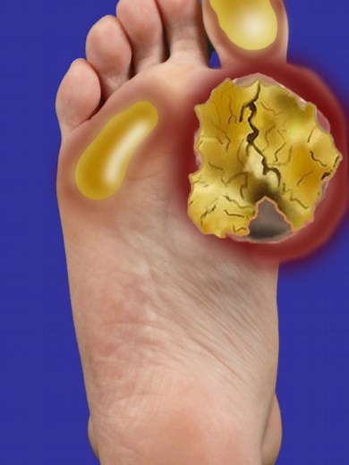 This foot callus removal transformation is incredibly satisfying. Watch the cracked skin cleaning and deep foot care ASMR animation until the end. Disclaimer: This video is a fictional ASMR animation created for entertainment purposes only. #footcaretreament #calluspeel #satisfyingvideos #OddlySatisfying