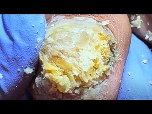 Toenail Turns Into A Yellow Stone, Remove The Bad Fungus Step By Step【Xue Yidao】