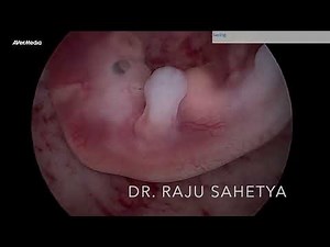 FETOSCOPY EMBRYOSCOPY
