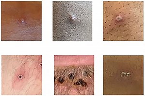 Monkeypox symptoms explained: What the signs of the infection are and how you can catch it